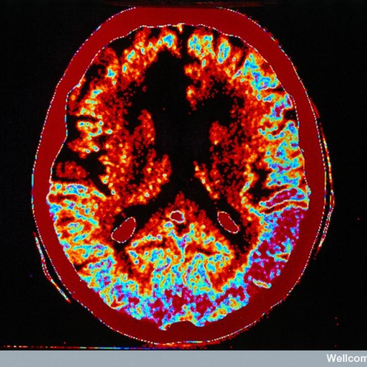 Stroke: how could stem cells help?