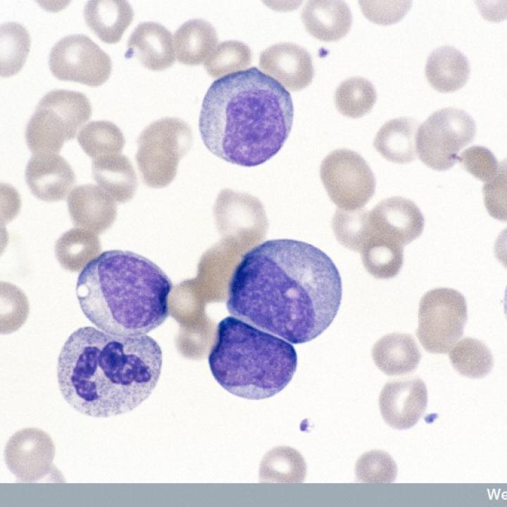 Smear of peripheral blood from a patient with chronic myeloid leukaemia