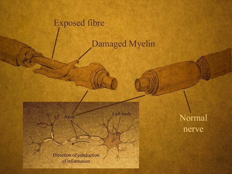 Diagram comparing damaged and healthy nerve