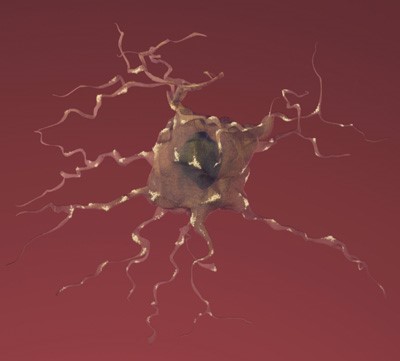 Drawing of a neuron affected by Alzheimer's disease