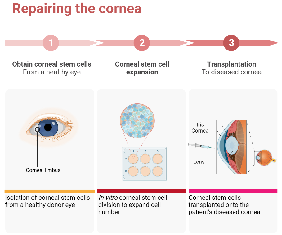 A diagram of the process of using stem cells to repair the damaged cornea