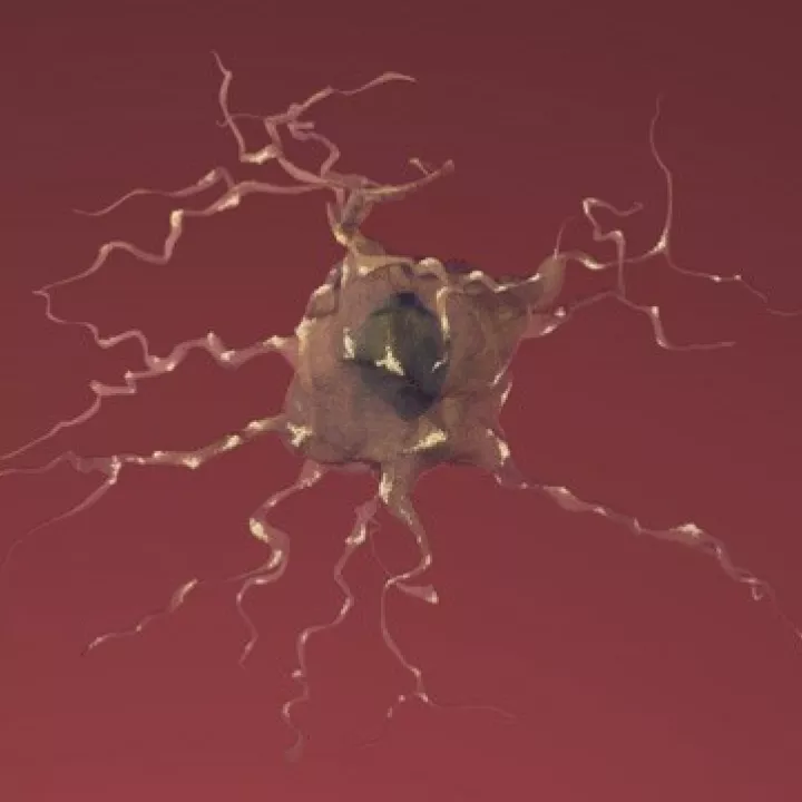 Illustration of a neuron affected by Alzheimer's Disease