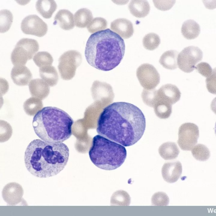 La leucémie : comment les cellules souches peuvent-elles aider?